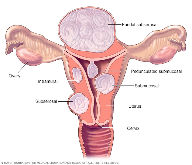 Types of fibroids