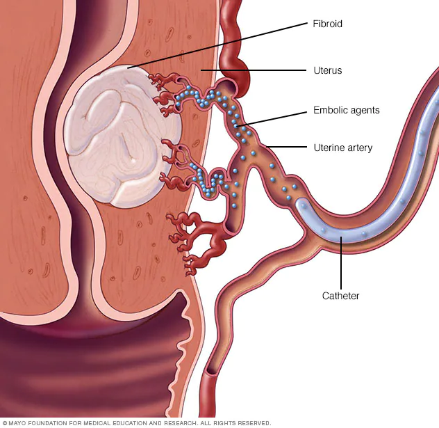 uterine fibroid embolisation diagram