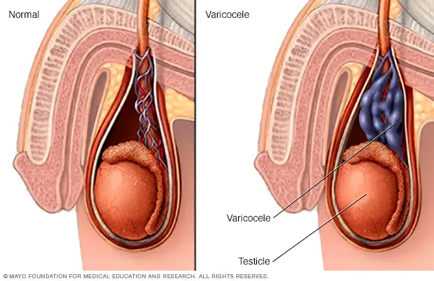 varicocele diagram